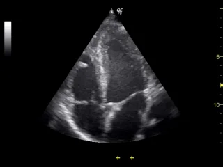 Echocardiogram of a beating heart in the four-chamber view, showing all four chambers and the tricuspid and mitral valves